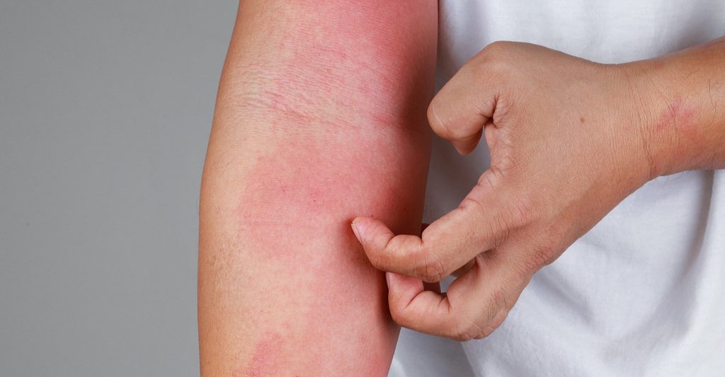 Bei den Behandlungsmöglichkeiten von Neurodermitis hat sich in den vergangenen zehn Jahren viel getan. Doch die Arzneimittelinnovationen erreichen nicht alle Patient:innen. Foto: ©iStock.com/