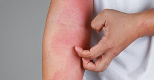 Bei den Behandlungsmöglichkeiten von Neurodermitis hat sich in den vergangenen zehn Jahren viel getan. Doch die Arzneimittelinnovationen erreichen nicht alle Patient:innen. Foto: ©iStock.com/